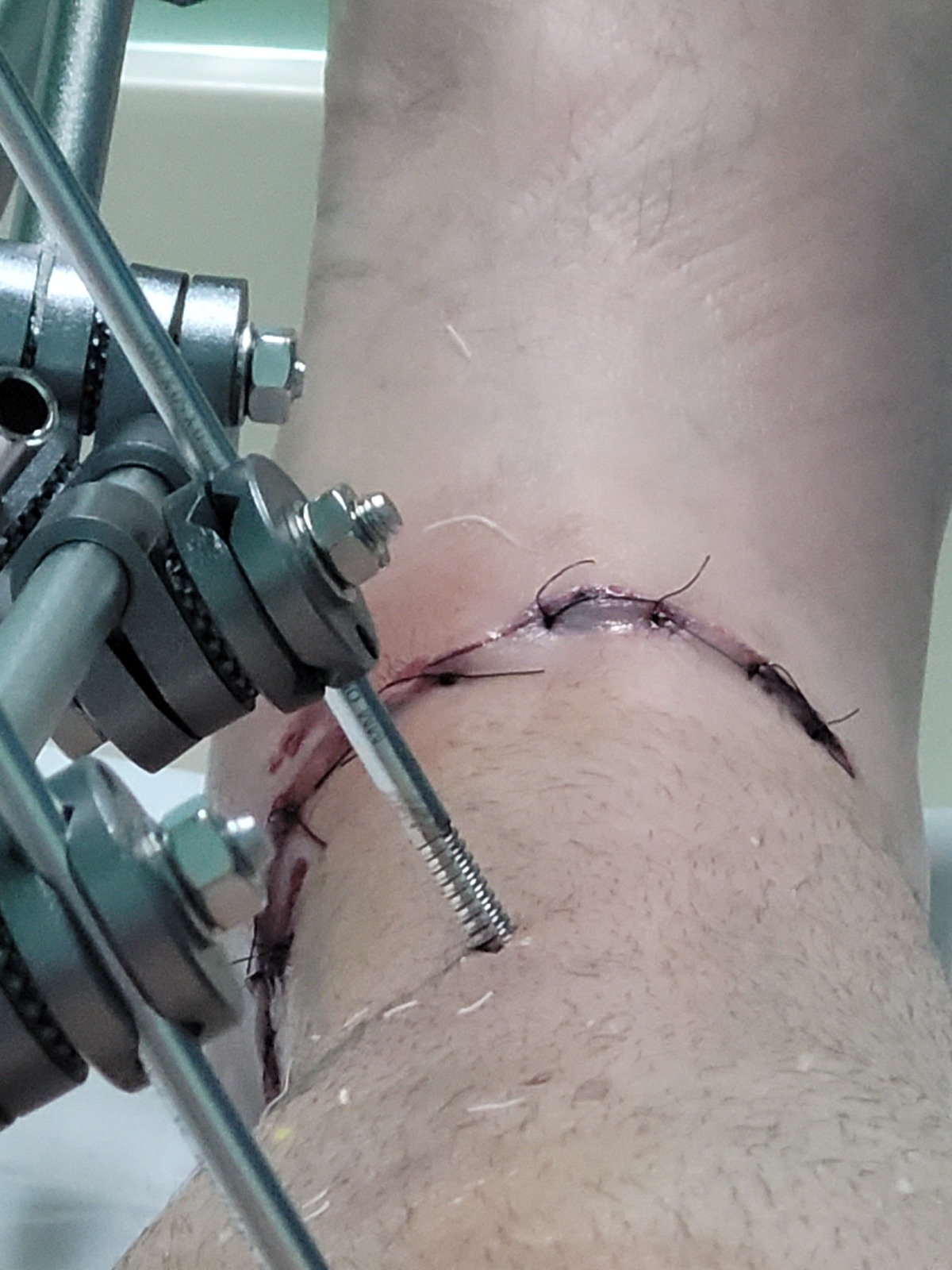 Fixador externo colocado na primeira cirurgia