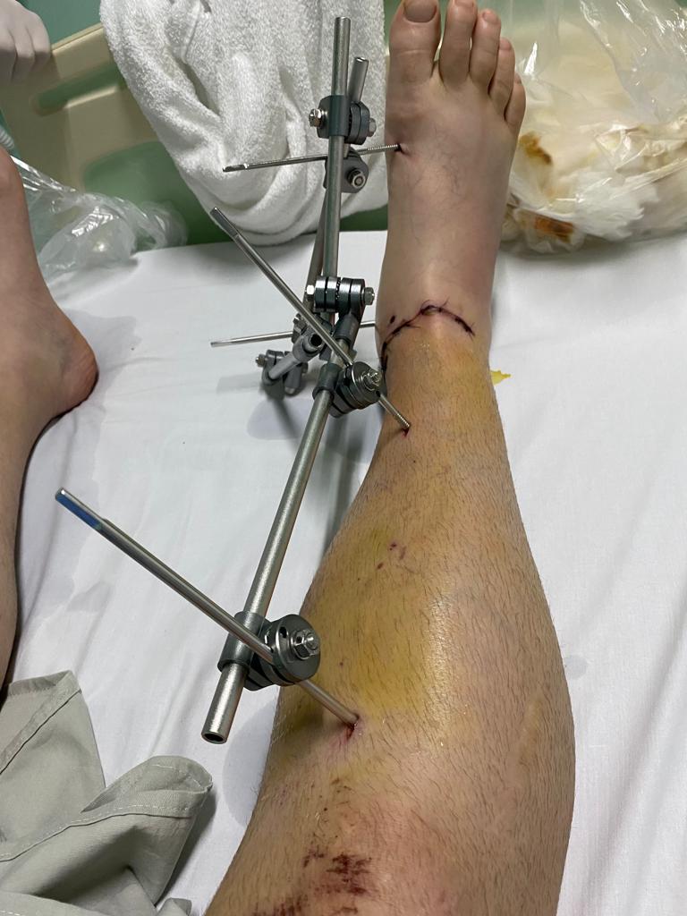 Perna com fixador externo durante a recuperação